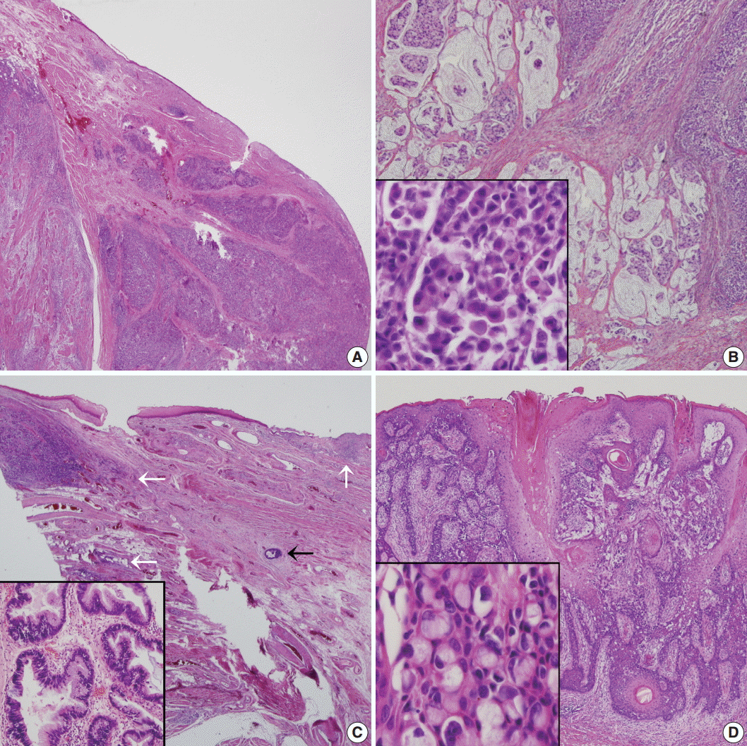 Adenocarcinoma of the Esophagus With Signet Ring Cell Features Portends a  Poor Prognosis